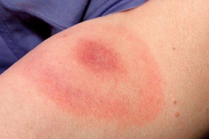 Tipica lesione a bersaglio da Malattia di Lyme (Immagine tratta da http://hardinmd.lib.uiowa.edu)